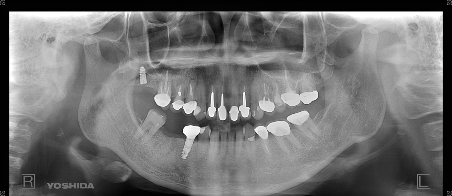 抜歯後骨造成後6か月　2021年4月　パノラマエックス線写真