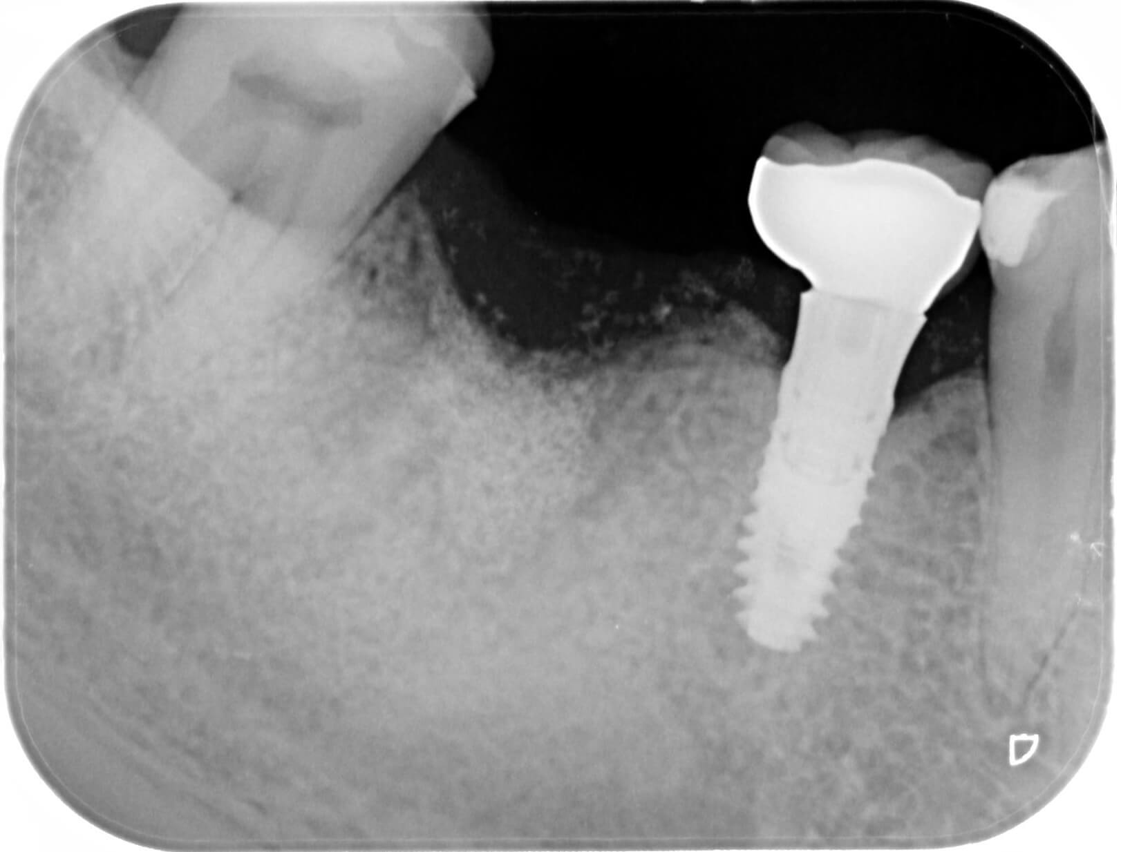 抜歯後骨造成後6か月　2021年4月　治療箇所のエックス線写真
